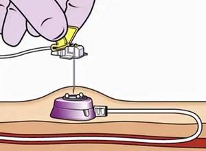 卓越服务︱“隐形”的输液神器——植入式输液港